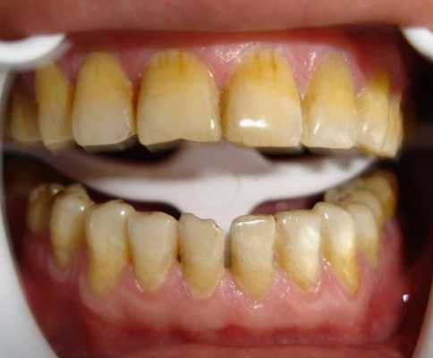 牙黄是什么