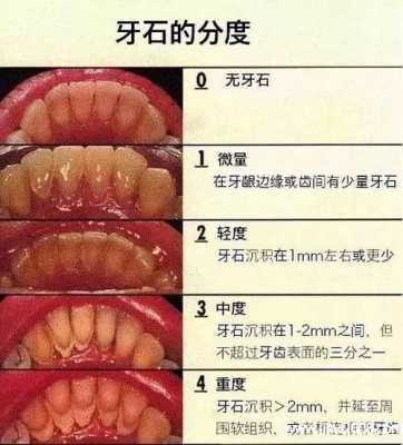 一度是什么意思,牙结石一度是什么意思 