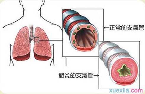 支气管上有结节怎么治疗方法-支气管上有结节是什么