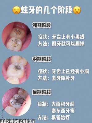 d6是什么意思（龋齿d6是什么意思）