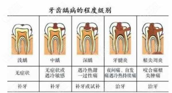 d6是什么意思（龋齿d6是什么意思）