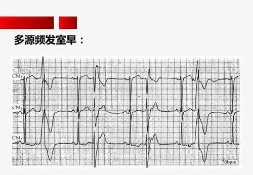 单发室早什么意思啊-单发室早是什么意思