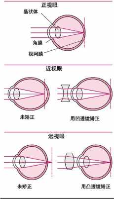 屈光不正最佳治疗方法 屈光不正是什么引起的